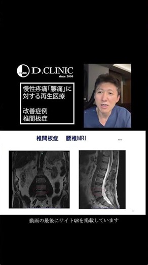 腰痛・椎間板ヘルニアが治らない・慢性疼痛の方へ10｜再生医療という新しい選択肢【幹細胞治療】10改善症例：椎間板症『慢性腰痛・椎間板ヘルニアへの新しい治療法』 #椎間板ヘルニア #腰痛改善