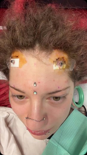 Silvio Lucchesi on Instagram: "👼TRANS DERMAL😈 Impianto sub dermale in titanio fabbricato dalle manine sante di @veleno.piercer , terminali cilindrici per la guarigione e poi andremo a posizionare dei terminali a calamita per l’ upgrade 😜 info in DM #bodymods #bodymod #piercer #bodypiercer #bodymodification #bodymodifications #professionalpiercer #bodypiercing #piercing #transdermal #implantsurgery #implant"