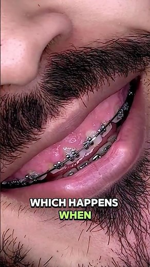 The Shocking Reason Behind Swollen Gums! 😱🦷