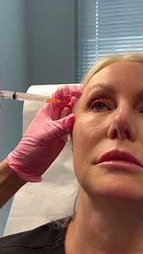 Sculptra Injections & Neck Rejuvenation | Dallas Dermatology Partners | Dr. DicksonFebruary 26, 2024