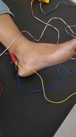 Dry Needle For Foot Pain/Reduce Foot pain/Needle Therapy/Dr.Anup