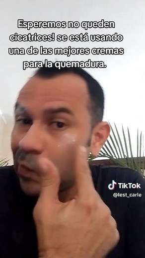 Mejores Cremas para Quemaduras y Cómo Cuidar la Piel