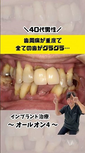 Introducing an All-on-4 case! A man in his 40s had loose teeth due to periodontal disease... #Nak...
