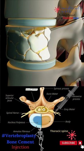 Bone Cement Injection - Vertebroplasty - Percutaneous Vertebral Augmentation - Spinal Cement