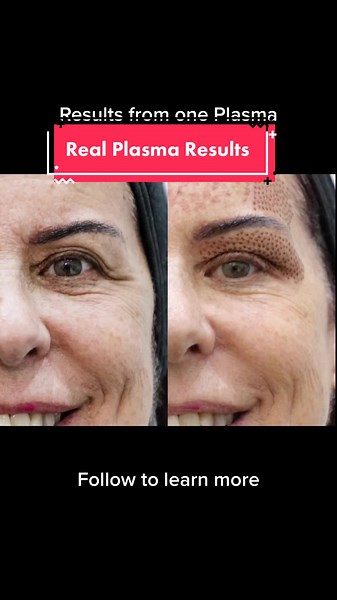 Not all Plasma results are like this, choose your practitioner wisely #amazingresults💪 #plasmapentreatment #realresults #plasmaeyelift #plasmafibroblast #nobotox #nofiller #medispa