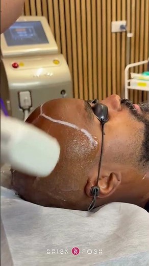 Scalp Hair Laser Hair Removal: Results & Experience