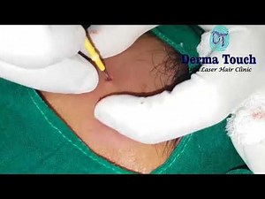Derma Touch Sebaceous cyst on forehead.