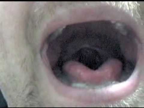 CPAP Continuous Positive Airway Pressure