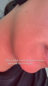 141K views · 13K reactions | Feeling self-conscious about unwanted facial hair? You're not alone. Many people experience this, and it's okay to seek a solution that works for you. Embrace your beauty and confidence, no matter what! | Ideal Image | Facebook