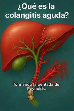 Acute cholangitis: Recognize it and act quickly!