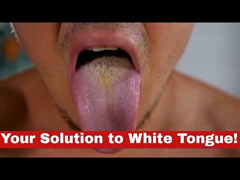 Amazing Transformation: How to Get Rid of White Tongue