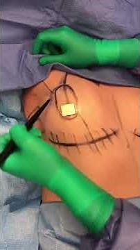 Toronto Plastic Surgery: Dr. Marc DuPere discusses top surgery for FTM transgender patients