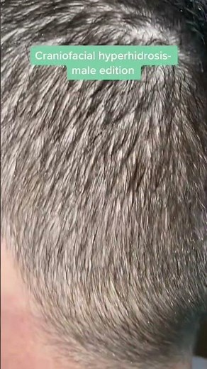 Craniofacial hyperhidrosis (excessive sweating of the head, face and scalp)