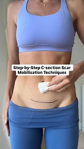 Comment ‘START’ for my FREE Step-by-Step Guide: How to Perform C-Section Scar Desensitization Scar sensitivity is common after a c-section, and desensitization can help your nerves calm down, reduce discomfort, and make touch feel normal again. After a C-section, your body has to heal through multiple layers of tissue. As these tissues heal, adhesions (stuck areas of scar tissue) can form. These adhesions can limit mobility, cause pain or discomfort, and even contribute to issues like lower back