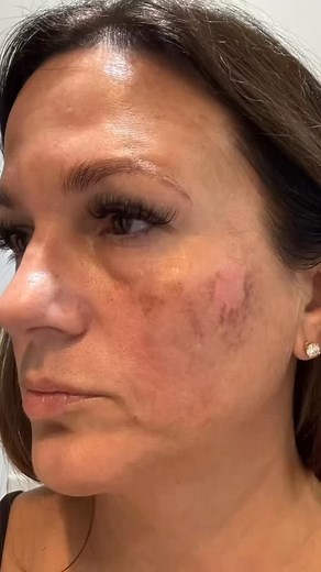 One treatment. YEARS of sun damage — lifted. This peel result was achieved using a professional Jessner Solution ✨ If you want to walk into summer with truly beautiful, healthy, glowing skin — chemical peel season starts NOW. This is where we correct sun damage, pigmentation, texture dullness… before the heavy sun months come back. This is your sign to start your peel series prep your summer skin early (your future self will thank you 🤍) Just don’t forget — SPF is non-negotiable. Protect your n