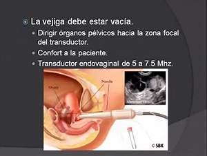 ECOGRAFÍA TRANSVAGINAL - video Dailymotion