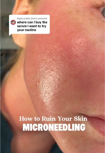 Microneedling At Home: Step-by-Step Guide