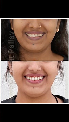 Braces off today! Anterior crossbite corrected — improving smile & ensuring long-term stability