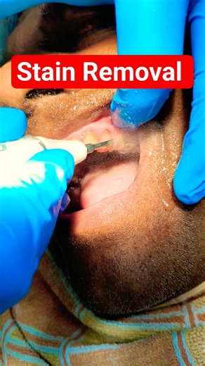 Removal of Stain By Machine #cleaning of Teeth by Ultrasonic Scaler #dental cleaning by Machine