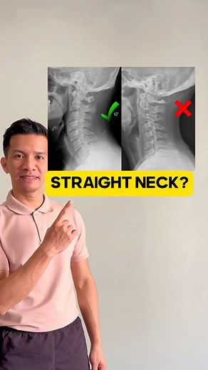 A straight neck, also known as loss of cervical lordosis, can result from various factors including poor posture, injury, muscle strain, disc degeneration, or conditions like cervical spondylosis. It can be influenced by prolonged use of electronic devices, excessive sitting, or improper sleeping positions, leading to changes in the natural curve of the neck. | Physical Therapy Session