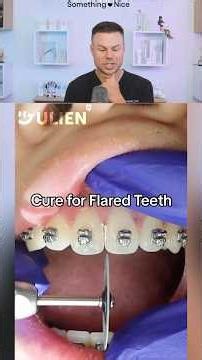 How Dentist Fix FLARED Teeth! 😮🦷