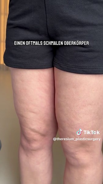 Woran erkennt man ein Lipödem?