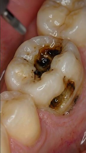 How Dentists Fix Cavities with White Fillings | #satisfying #dentist #asmr #toothcraft