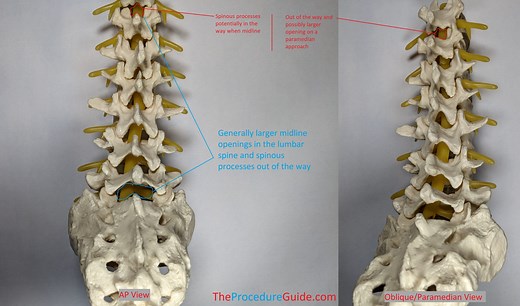 Fluoroscopic Guided Thoracic/Lumbar Interlaminar Epidural Steroid Injection – Technique and Overview - The Procedure Guide