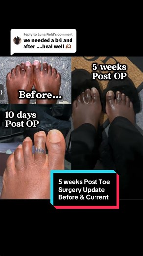 Replying to @Luna Field I HATEEEEEED my feet so never took pictures and barely had videos. Hope this help with the before and after. Surgeon: @Dr Foot Location: Birmingham Surgery Name: Corn/lesion skin removal surgery #toesurgery #skinremovalsurgery