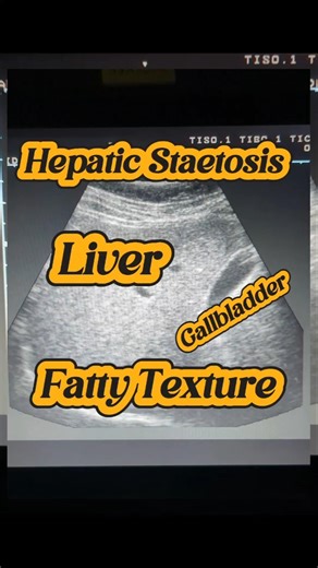 Fatty liver on ultrasound | Hepatic staetosis | Fatty Liver | Hepatomegaly