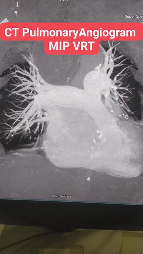 CT PULMONARY ANGIOGRAM -MIP, MIP THIN, VRT, CINEMATIC RENDER #radiographer #radiology #education #radiography #CT #ctscanner #MRI #MRCP #MedicalImaging | Maruf Bhuiyan The Radiographer