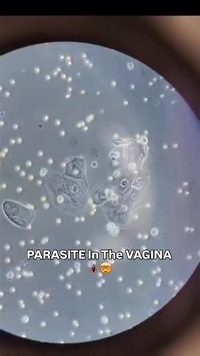 This is what a vaginal parasite actually looks like under the microscope. Yes… it really moves like that. What you’re seeing here is Trichomonas vaginalis, a sexually transmitted parasite. It’s transmitted through sexual contact and commonly causes vaginal discharge, itching, irritation, and discomfort, though many people can be asymptomatic. In this video, you can see its characteristic jerky, tumbling motility, and it’s literally dragging a red blood cell along as it moves through the urine se