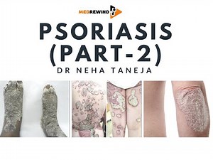Psoriasis - Types, Symptoms and Diagnosis (Part - 2)