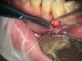 Grafting With Purified Collagen Implants • Video • MEDtube.net
