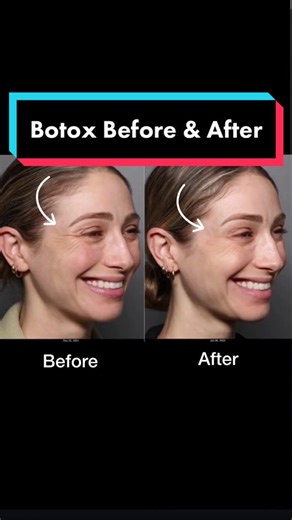“Baby Botox” to soften lines and provide subtle brow lift #botox #drkatiebeleznay #beforeandafter Video courtesy of @jillian.lansky 🤍