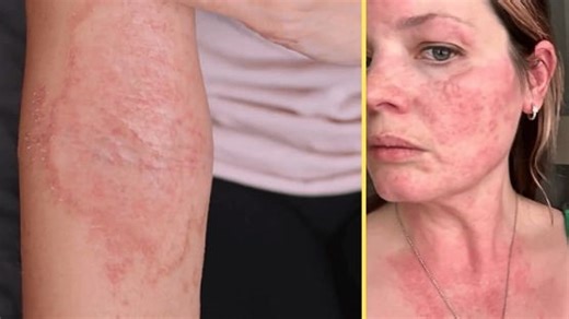 Can cold weather trigger an allergic reaction? Here's what experts say - The Weather Network