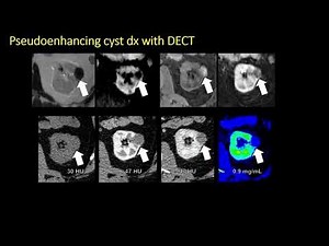 Role of dual energy CT in renal mass imaging