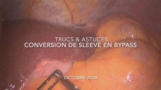Transformation d'une sleeve en bypass.