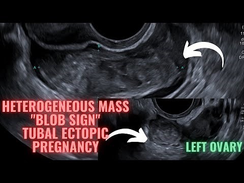 Ultrasound Pregnancy Tubal Ectopic Pregnancy (Blob Sign). Diagnosis criteria.
