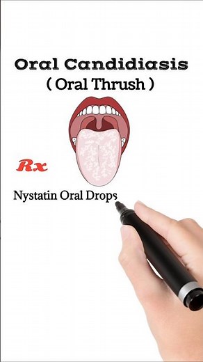 Oral Thrush ( Oral Candidiasis ) treatment