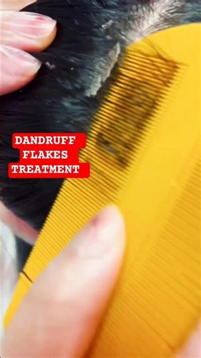 Dandruff scratching 😋😔 #dandrufftreatment #dandruff #dandruffscratching #DandruffCare ‪@MadPASMR‬