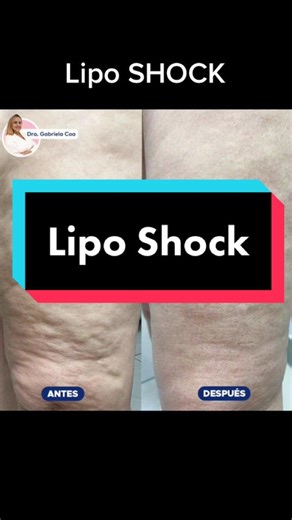 LipoShock #lipo #celulitis🤢😰 #tratamientocelulitis #ondasdechoquefocalizada #celulitisygrasa😭