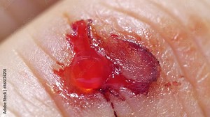 Injury of middle finger of right hand with bleeding. Flayed skin, blood and lymphatic fluid flows from wound
