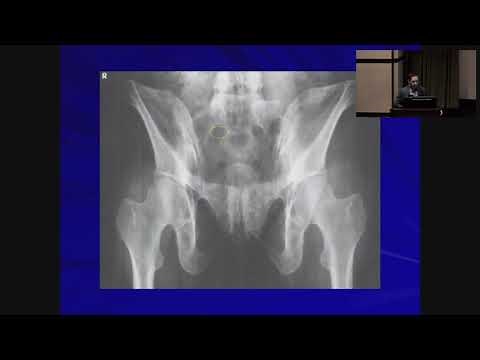 Pelvic and Acetabular Fractures - Anthony Spinnickie, MD