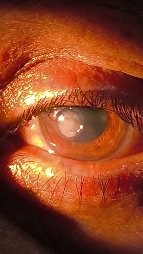 Large corneal ulcer progressing to perforation – outcome of foreign body removal by quacks.