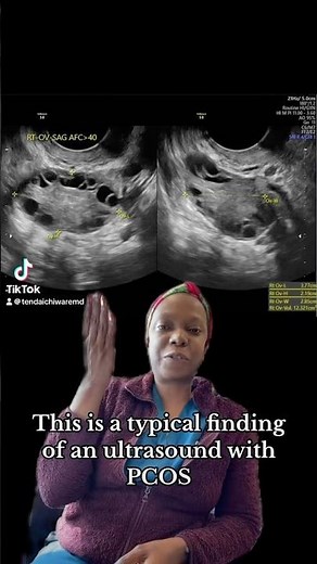What does PCOS look like on ultrasound?