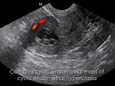 CASE 1096 cystic endometrial hyperplasia