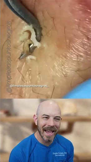 The Risks and Techniques of Deep Comedone Extractions