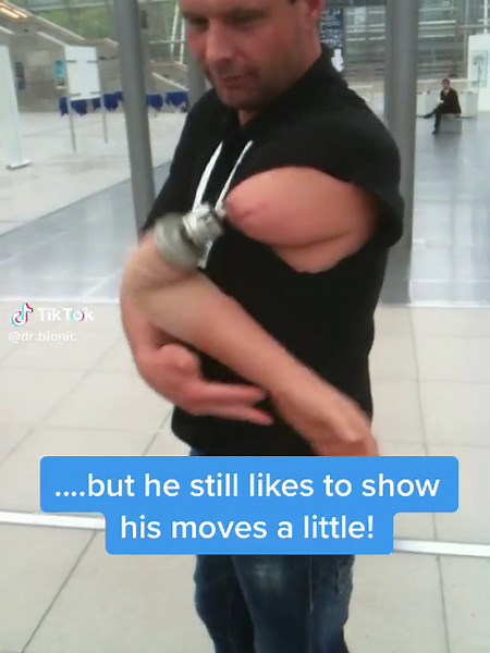 Osseointegration Moves: Patient Demonstrates Bionic Arm Prosthesis