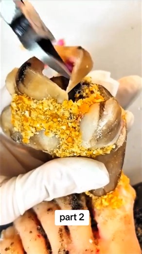 Ingrown Toenail Removal Treatment | Step-by-Step Cleaning Process | CTH TV2